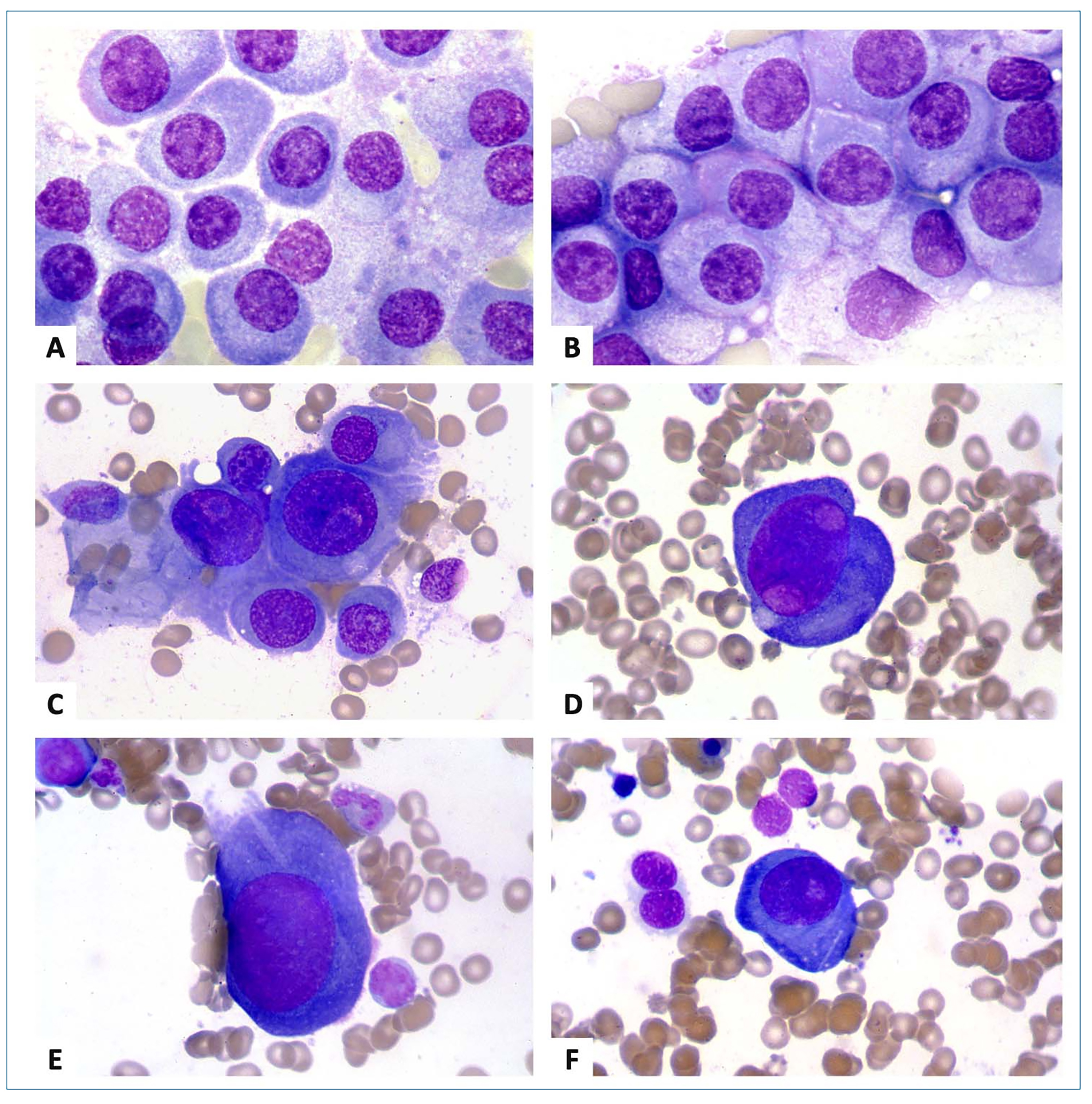 plasma cell clock face