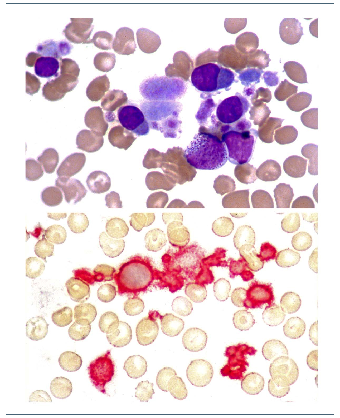 Images From The Haematologica Atlas Of Hematologic Cytology Primary
