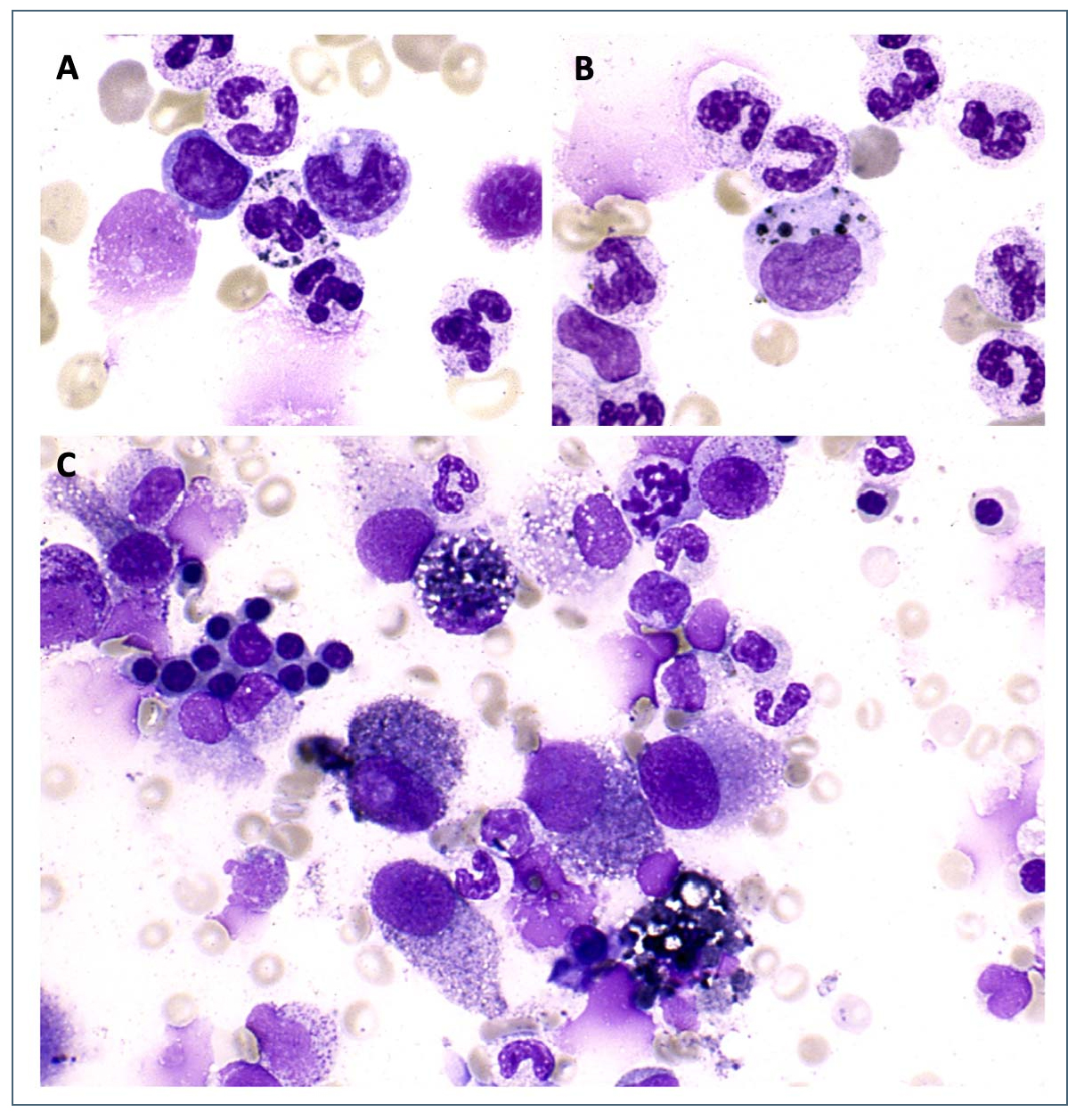 Malignant Melanoma Cells