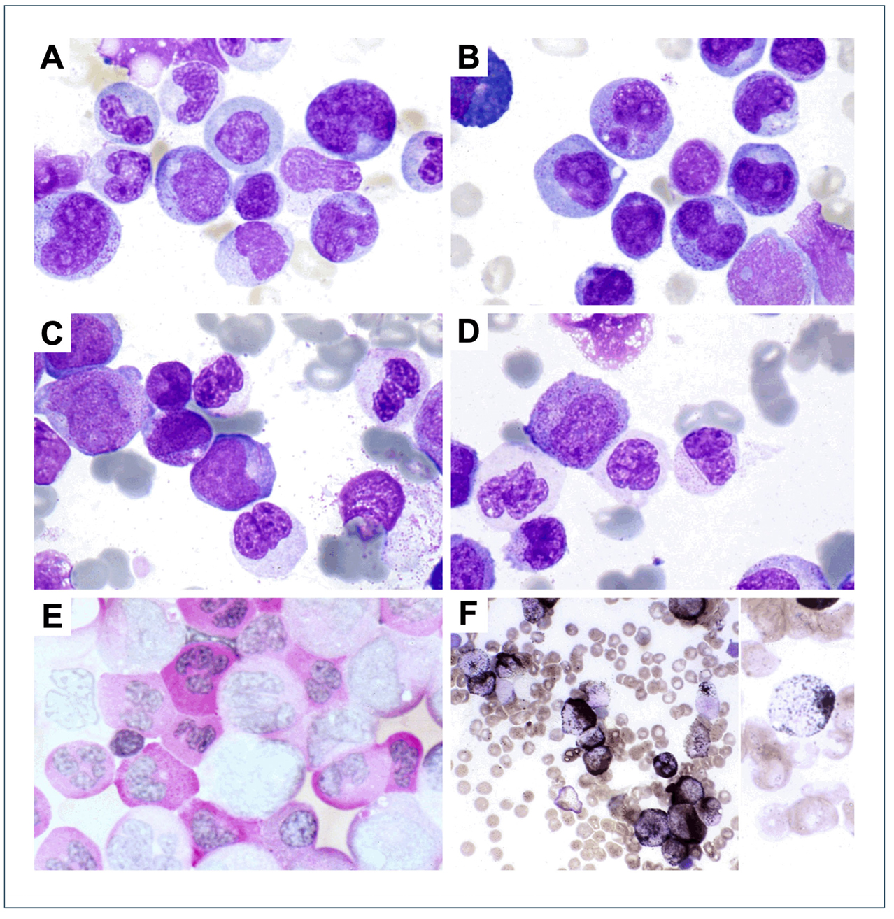 acute leukemia cells