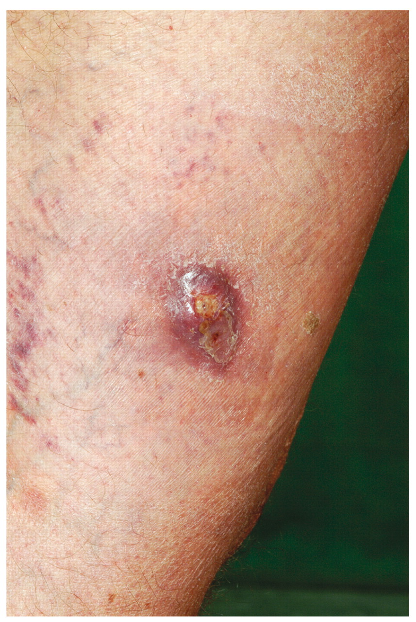 Mycobacterium Skin Lesions