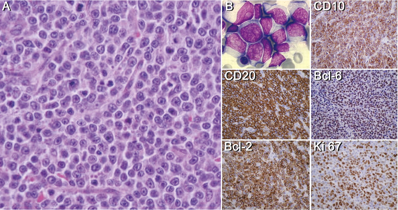 The Clinical Presentation And Prognosis Of Diffuse Large B Cell Lymphoma With T1418 And 8q24 