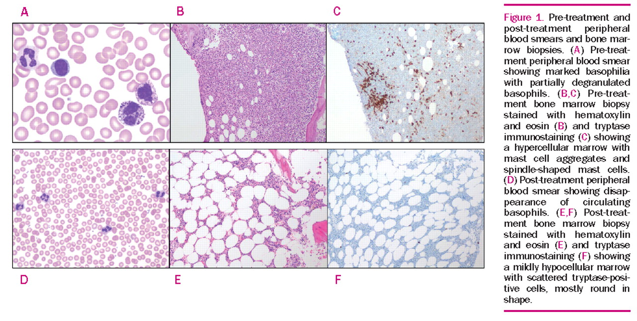 RBCP - Revisiting Postbariatric Monsplasty