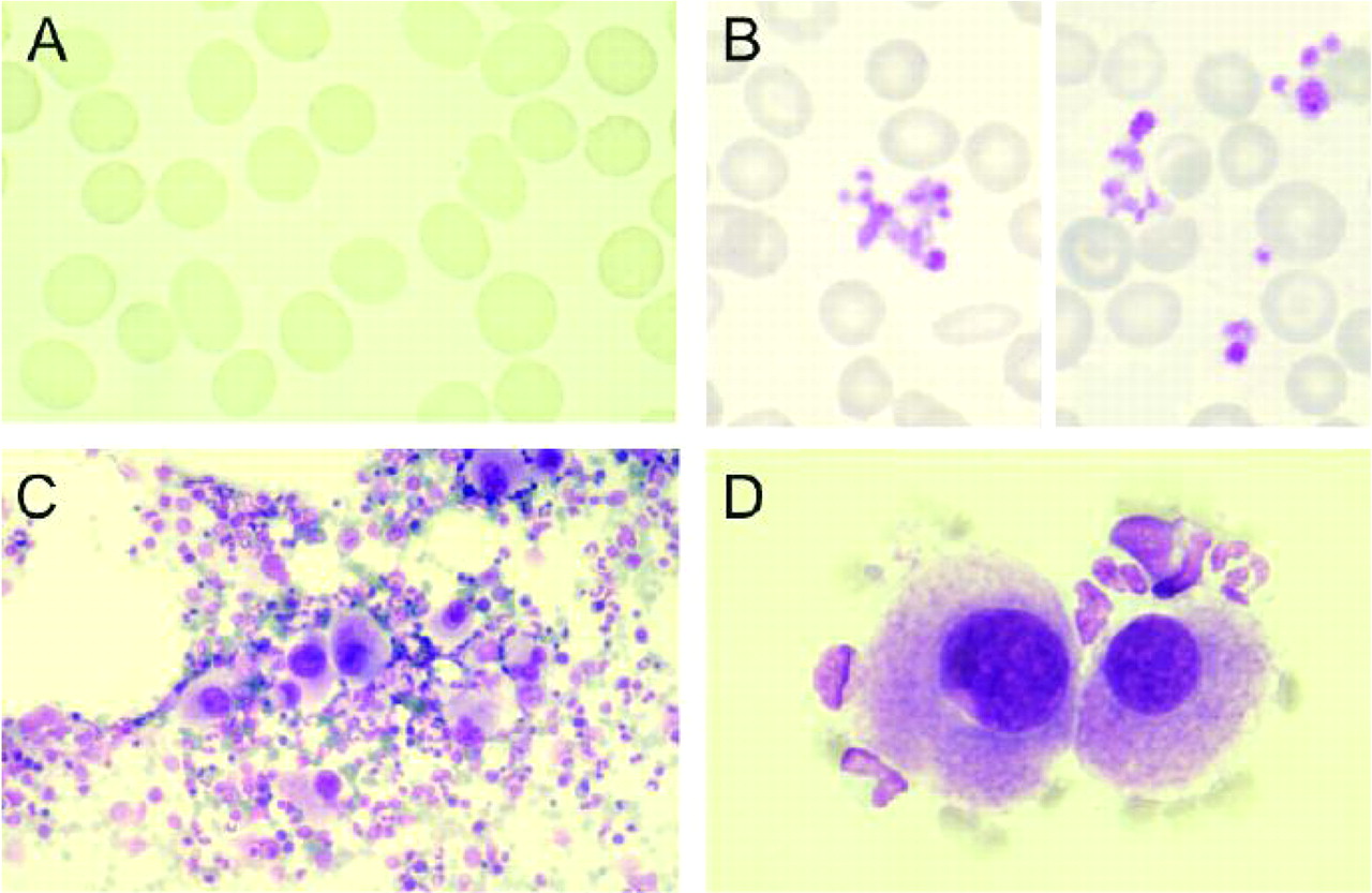 Myelodysplastic syndrome with isolated 5q deletion (5q- syndrome). A