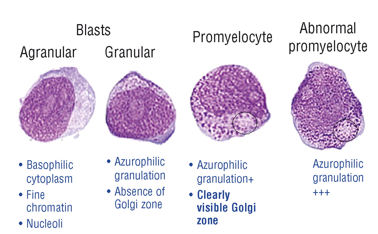 myeloblast vs promyelocyte