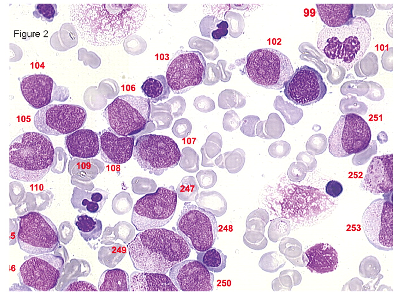 myelodysplastic syndrome