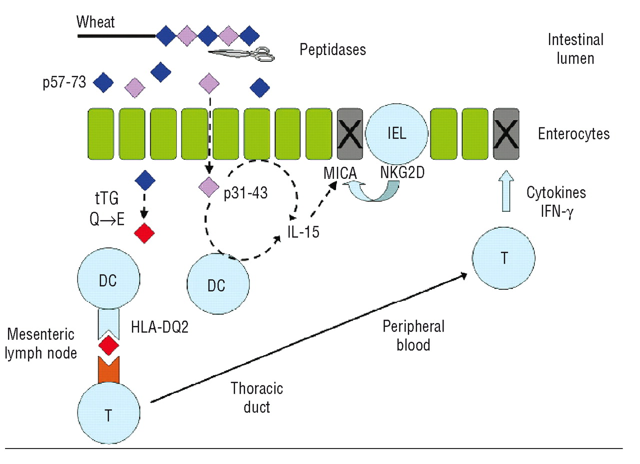 Ironing Out The Mechanism Of Anemia In Celiac Disease Haematologica