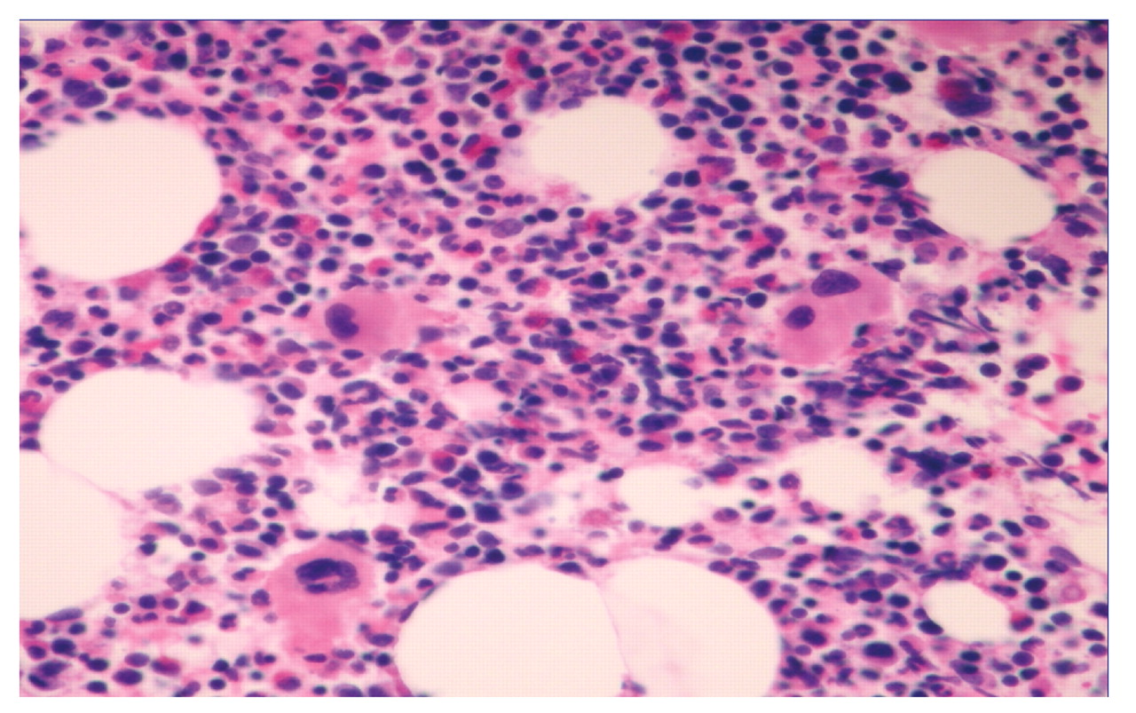 Diagnostic criteria to distinguish hypocellular acute ...