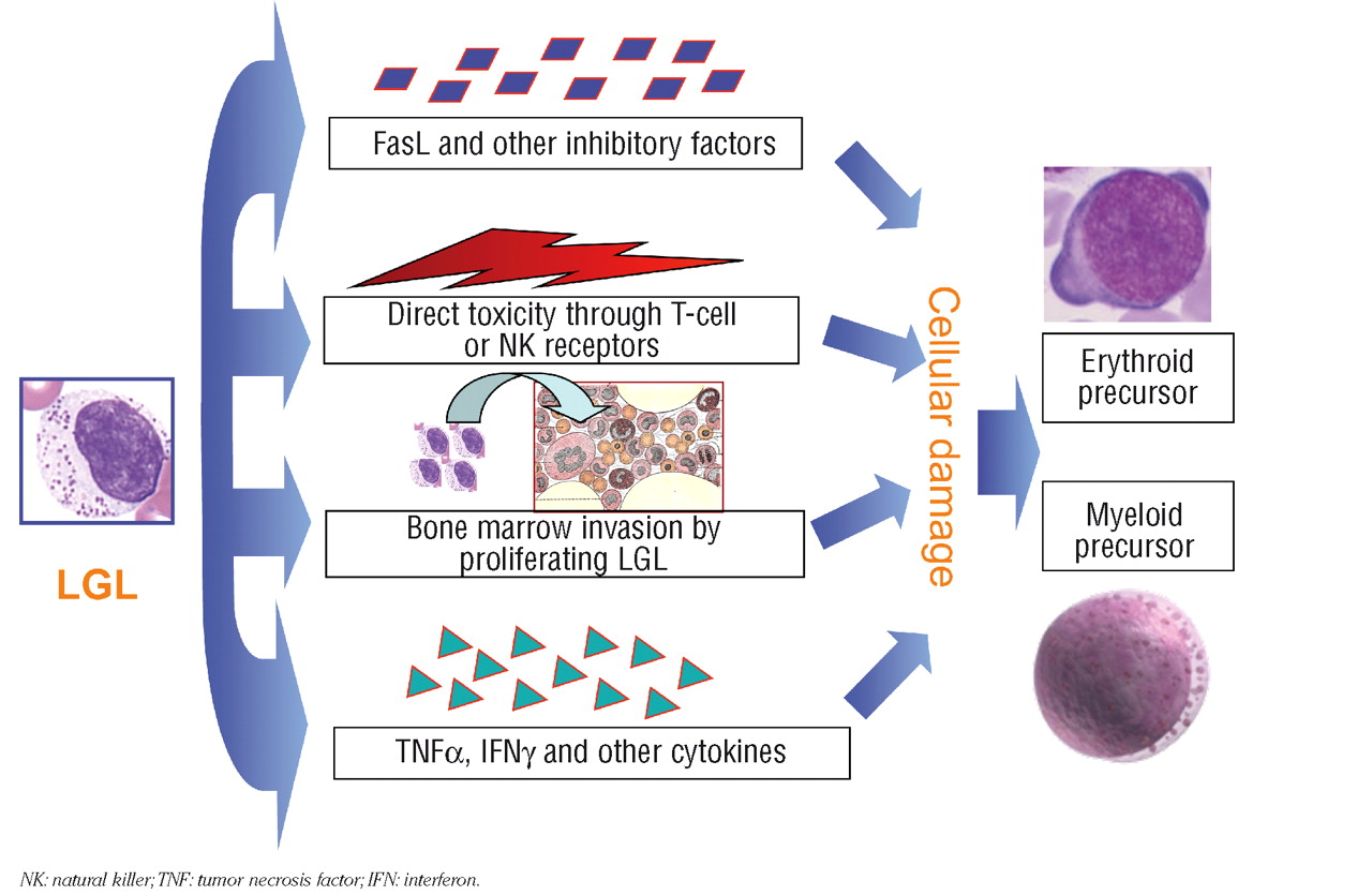 lgl leukemia icd 9 code