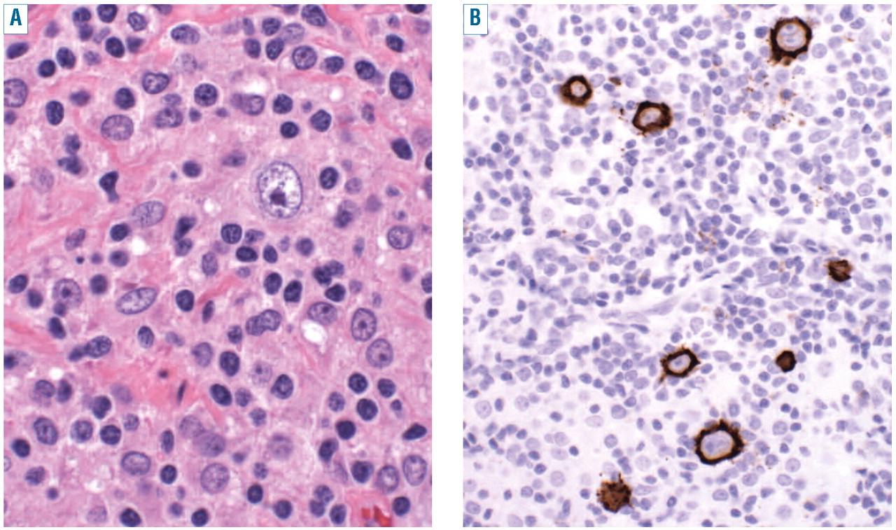 histiocytes