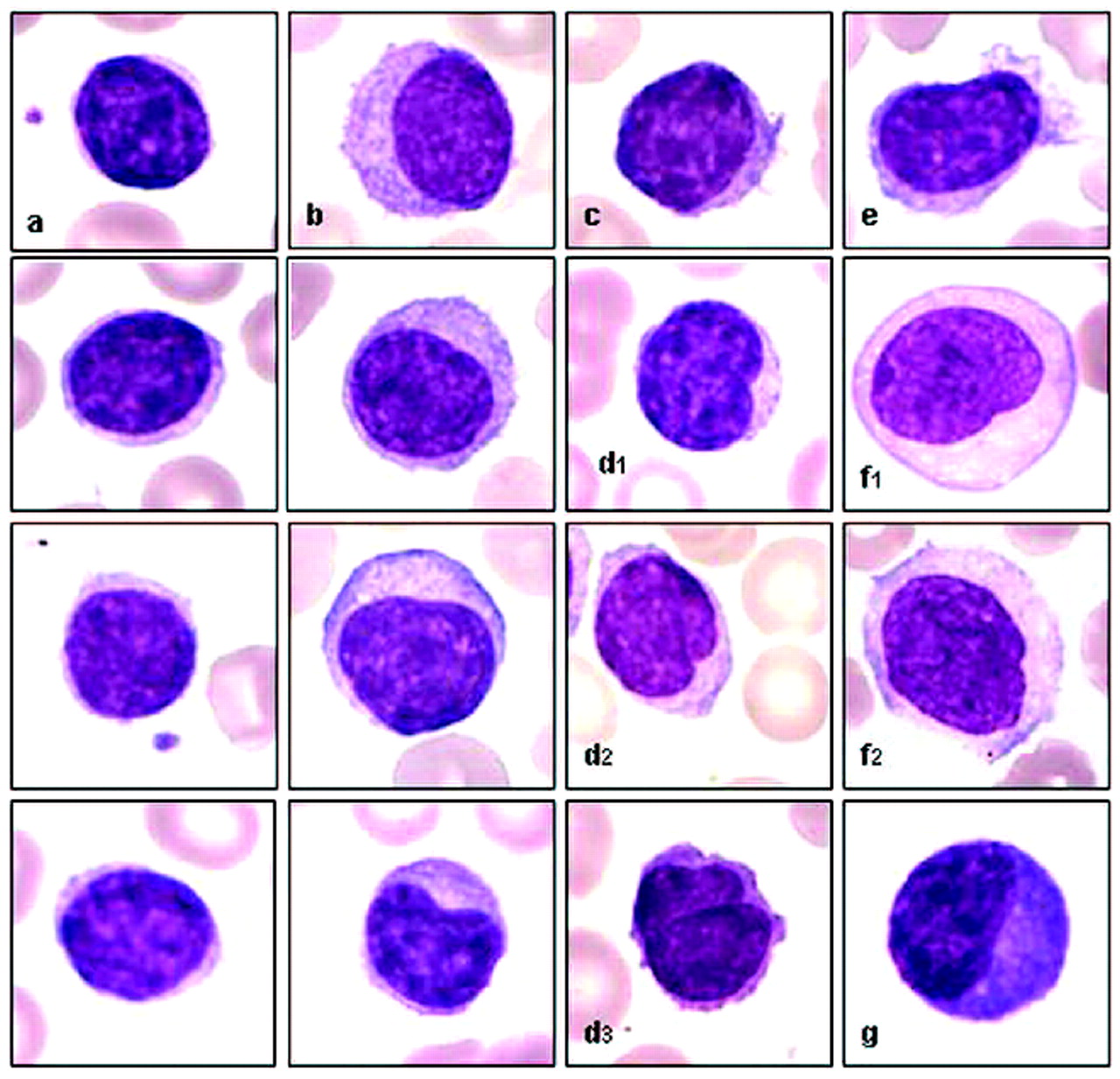 splenic marginal zone lymphoma