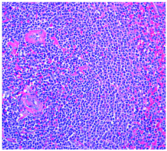 splenic marginal zone lymphoma