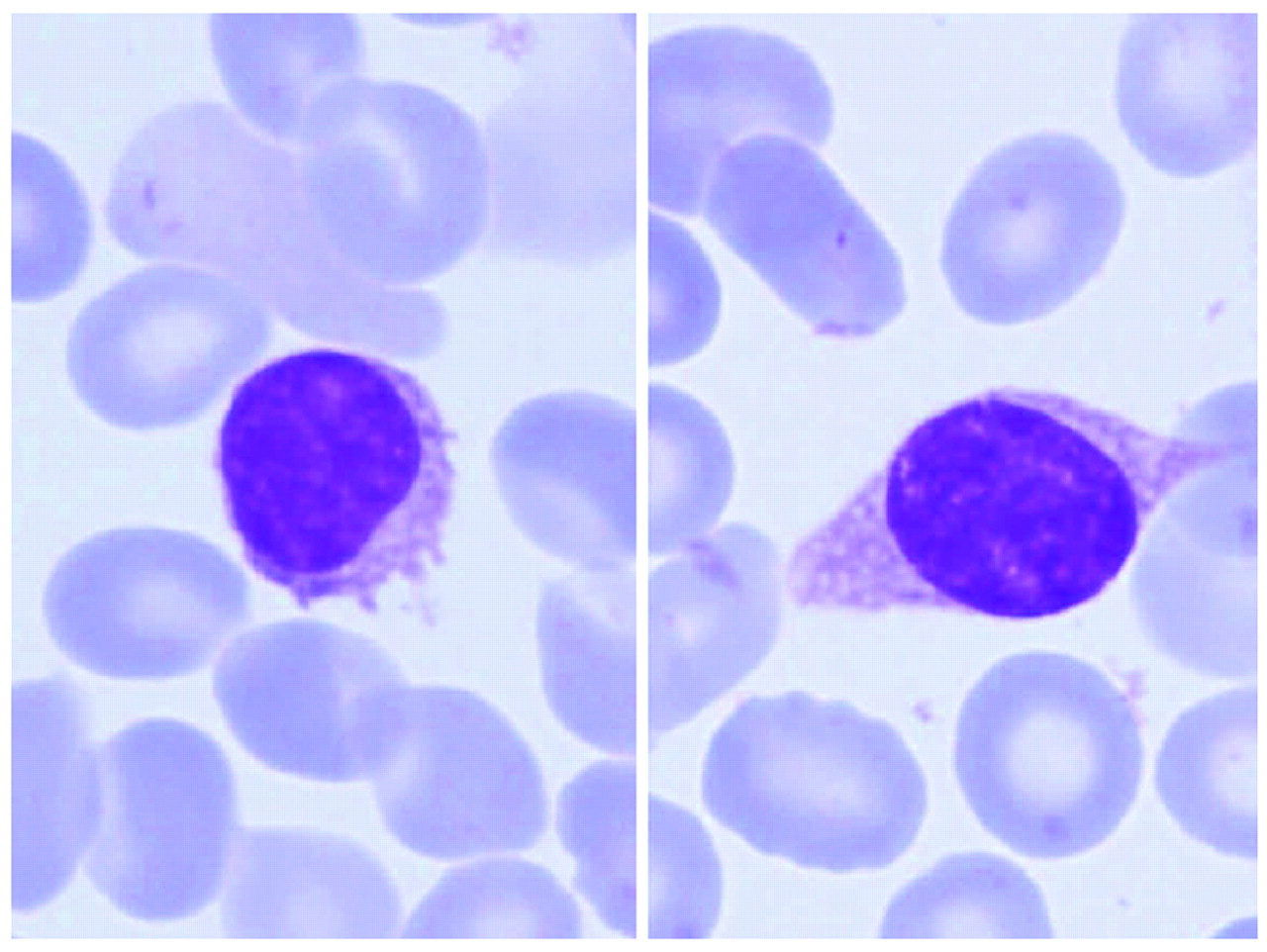 Splenic diffuse red pulp small B-cell lymphoma: revision of a series of ...