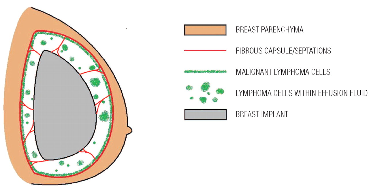 Breast Implant-Associated Anaplastic Large Cell Lymphoma (BIA-ALCL)