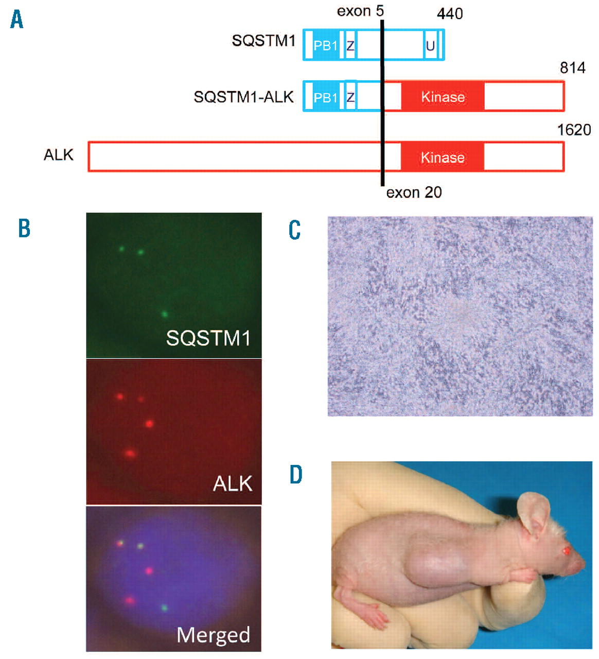 identification-of-a-novel-fusion-sqstm1-alk-in-alk-positive-large-b