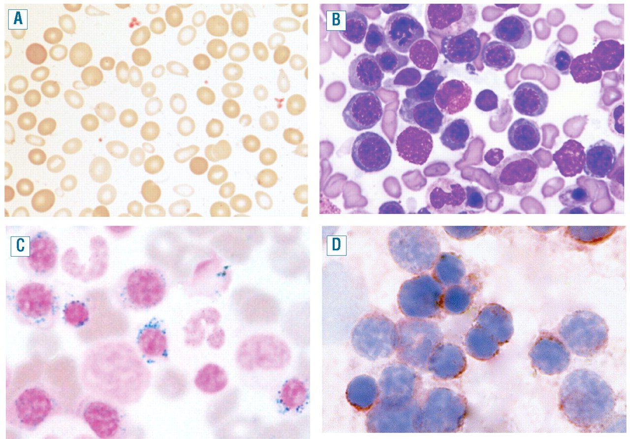 ringed sideroblasts