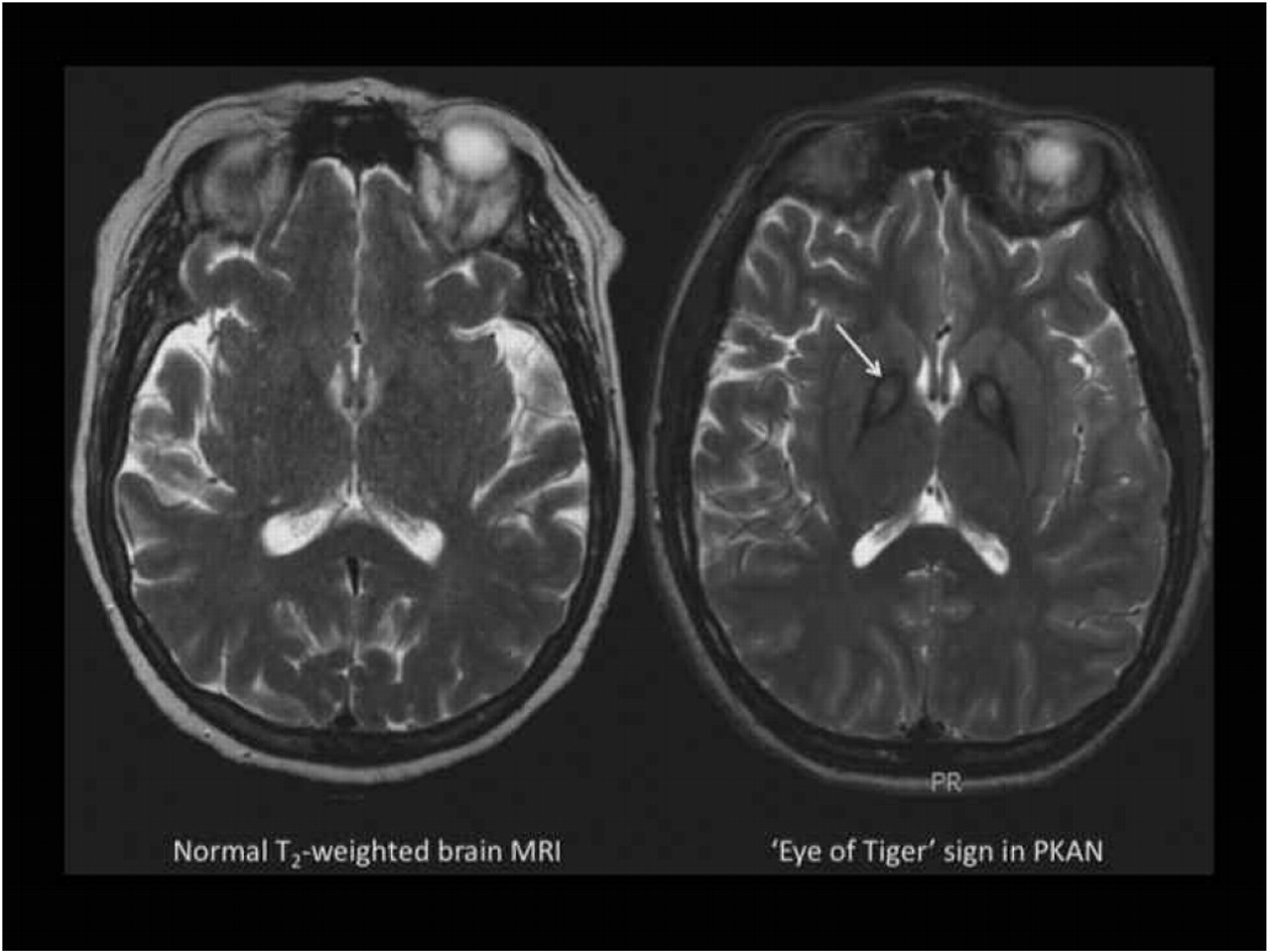 As Iron Goes So Goes Disease Haematologica