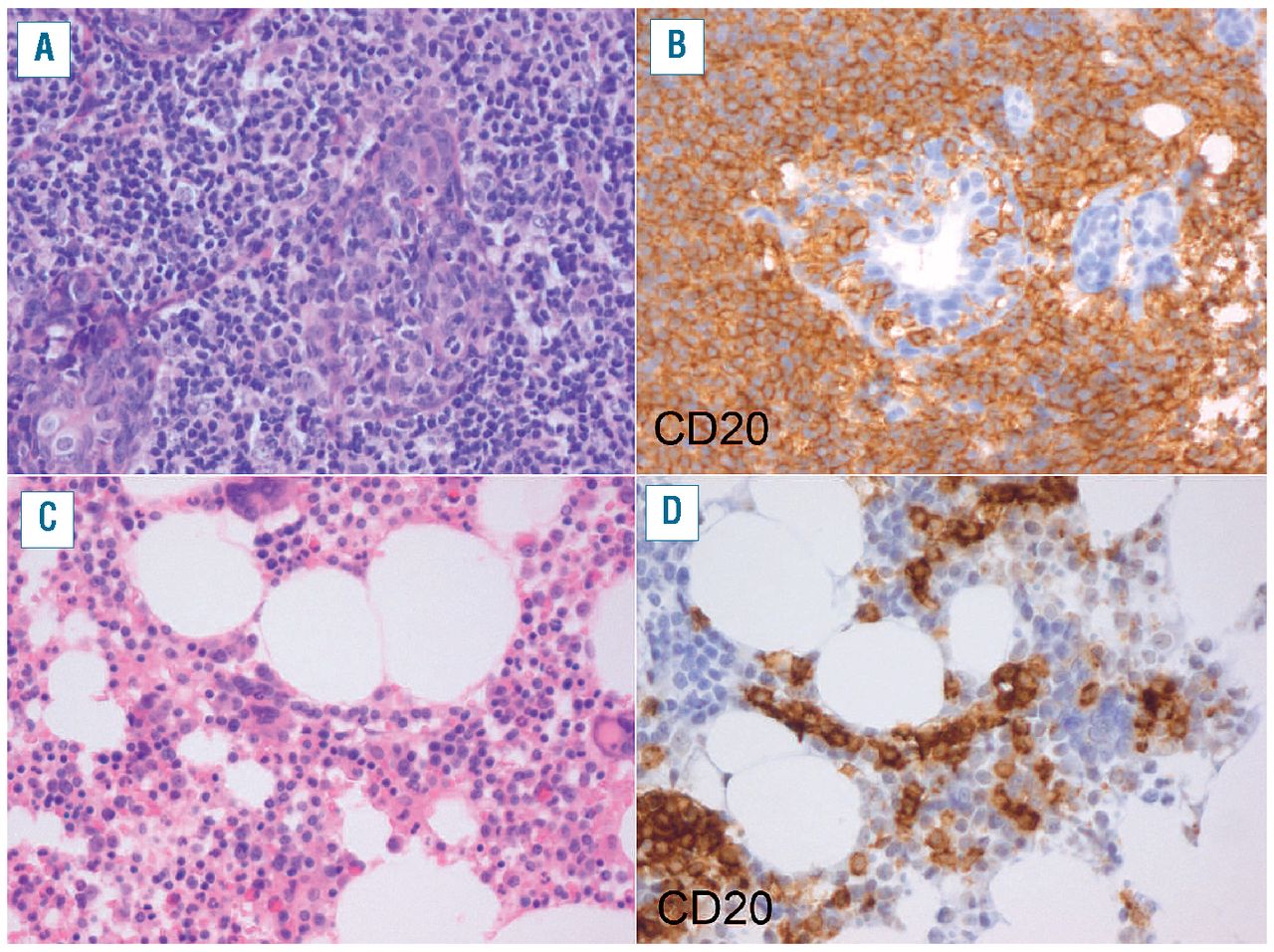 splenic marginal zone lymphoma