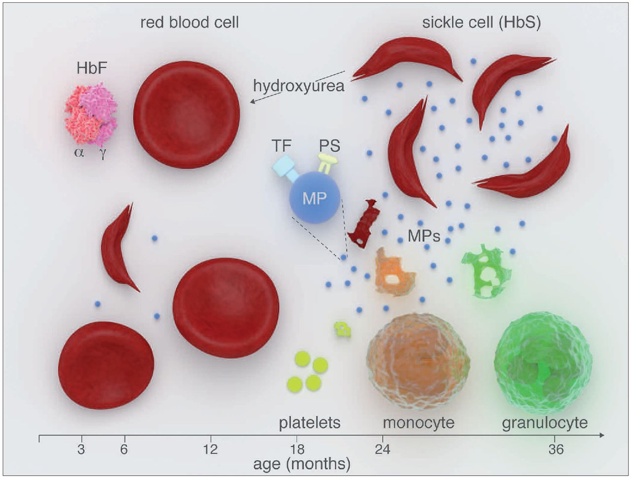 sickle cell anemia hemoglobin