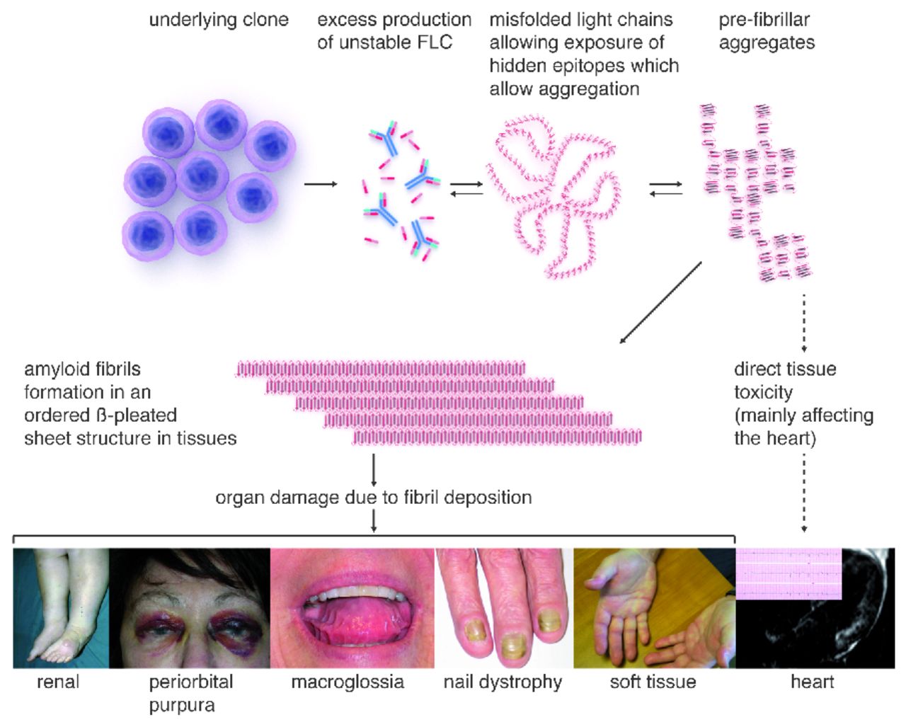 primary systemic amyloidosis