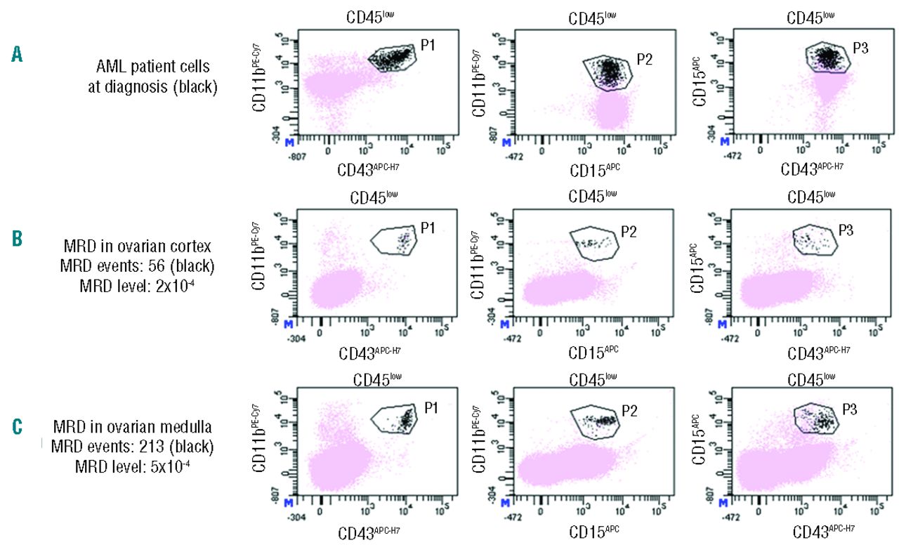 Minimal Residual Disease Detection In Cryopreserved Ovarian Tissue By Multicolor Flow Cytometry