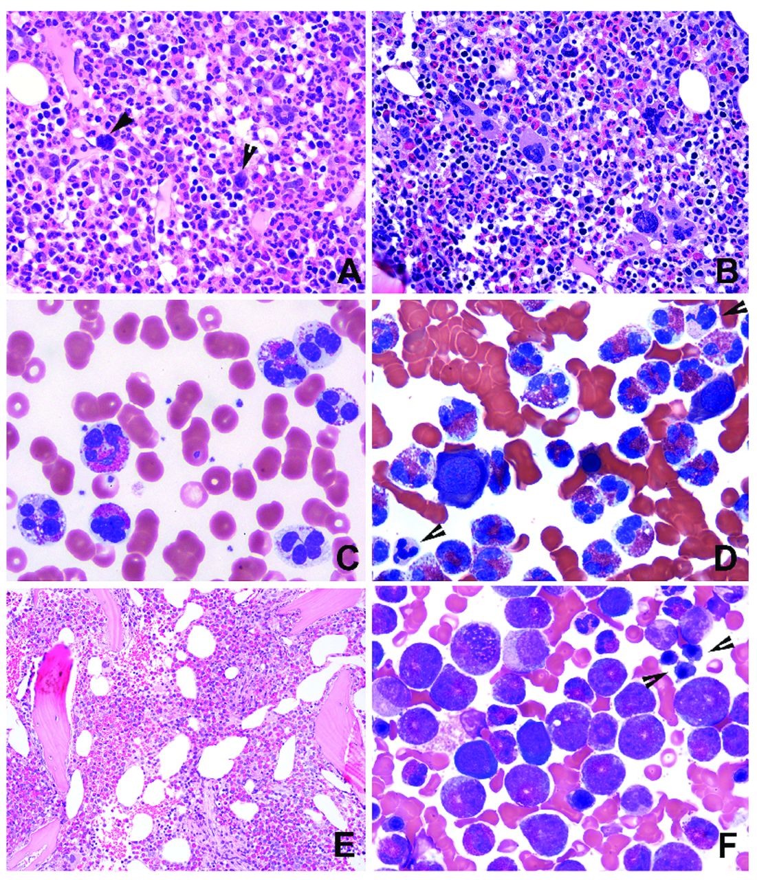 Bone Marrow Morphology Is A Strong Discriminator Between Chronic