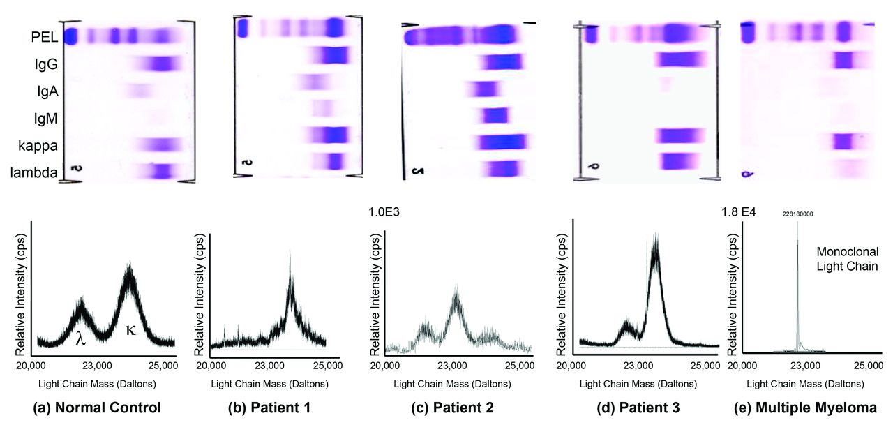 Doen Thespian agentschap Pseudo-monoclonal gammopathy: a report of four cases | Haematologica