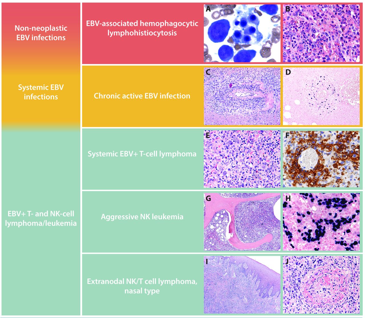 defining-the-elusive-boundaries-of-chronic-active-epstein-barr-virus