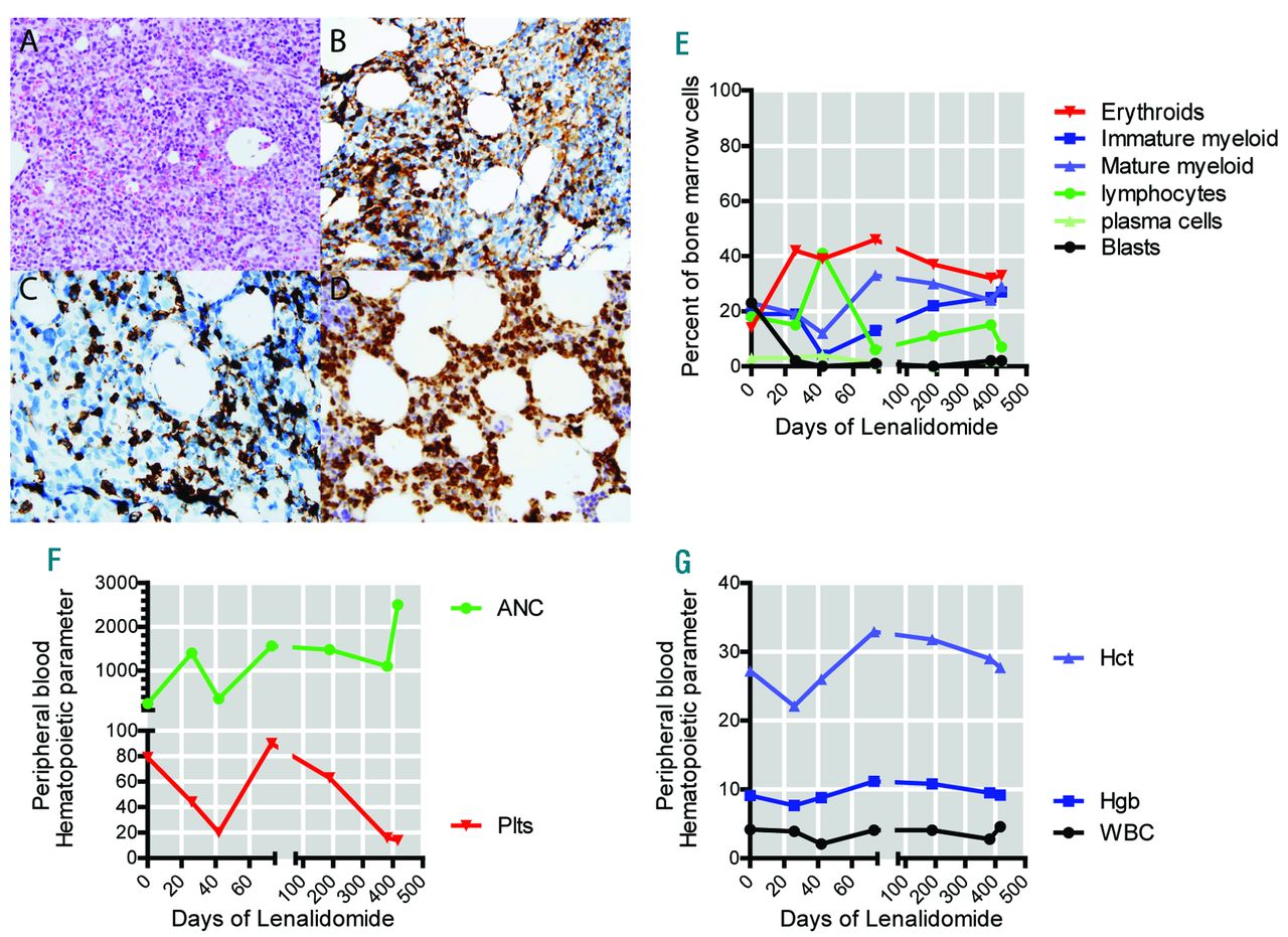 Lenalidomide Results In A Durable Complete Remission In Acute Myeloid Leukemia Accompanied By Persistence Of Somatic Mutations And A T Cell Infiltrate In The Bone Marrow Haematologica