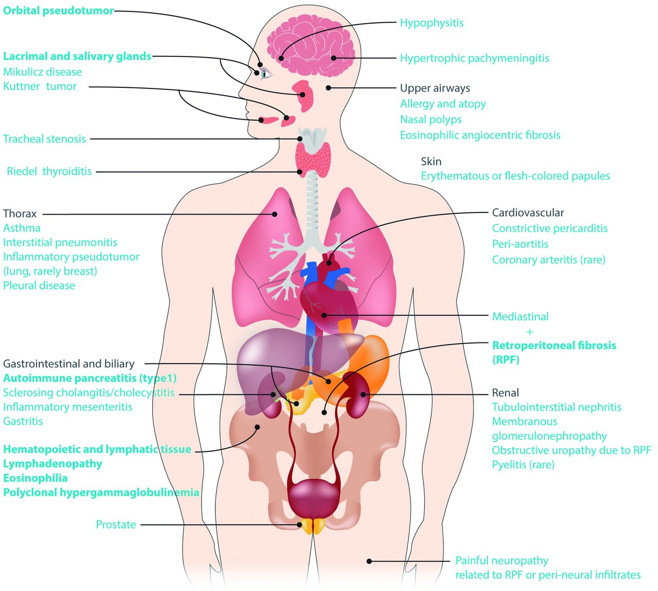 IgG4-related disease: what a hematologist needs to know | Haematologica