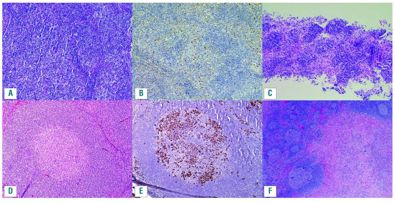 Igg4 Related Disease What A Hematologist Needs To Know Haematologica