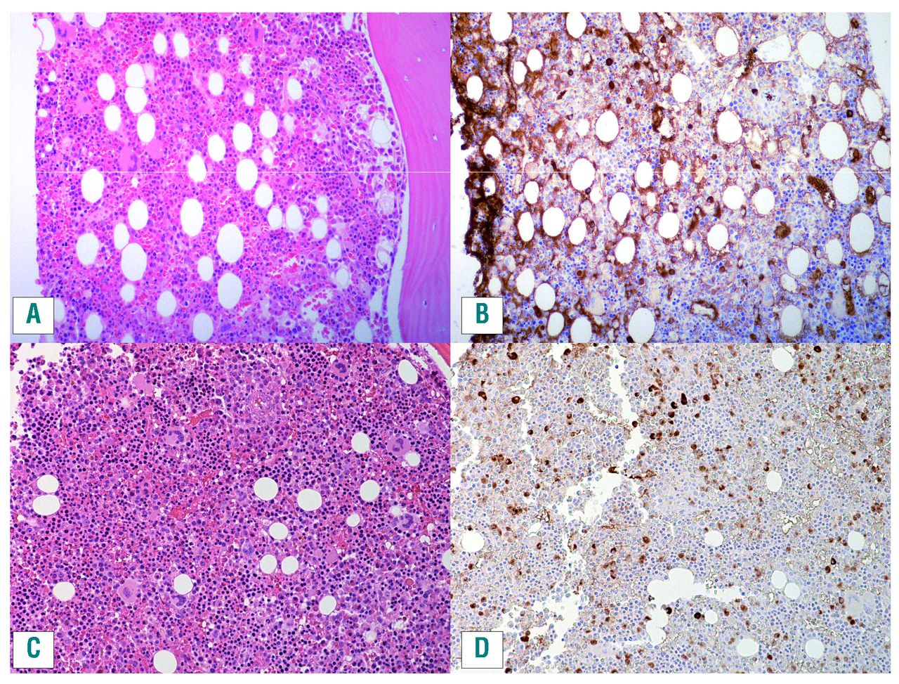 IgG4-related disease: what a hematologist needs to know | Haematologica