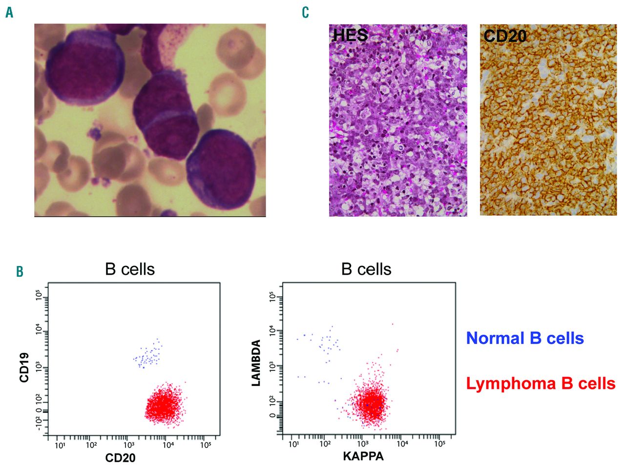 Molecular analysis of a CD19negative diffuse large Bcell