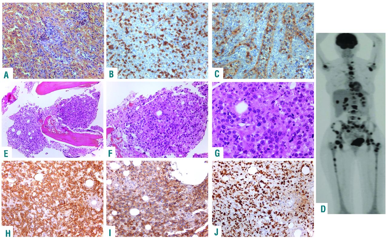 lgl leukemia icd 9 code