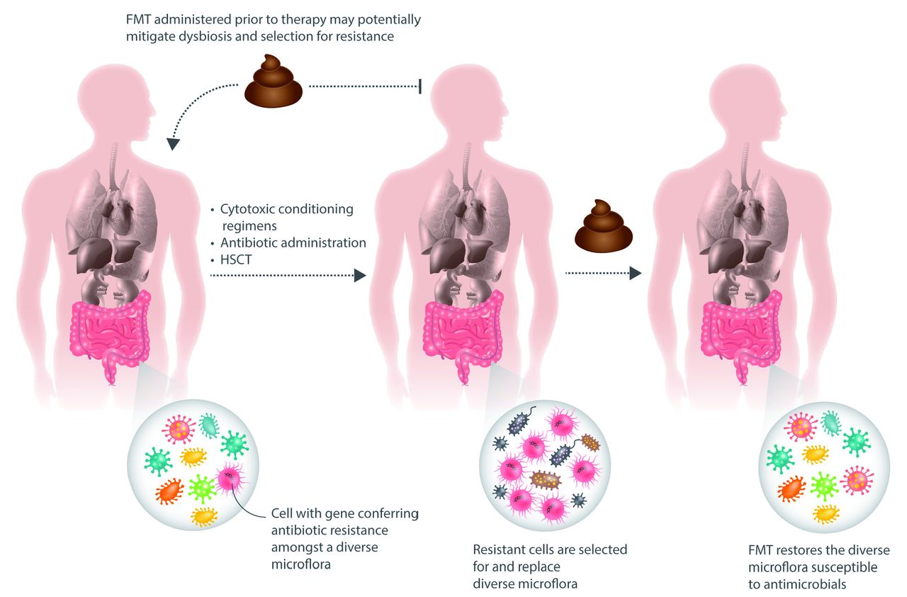 Dysbiosis a gi-ben