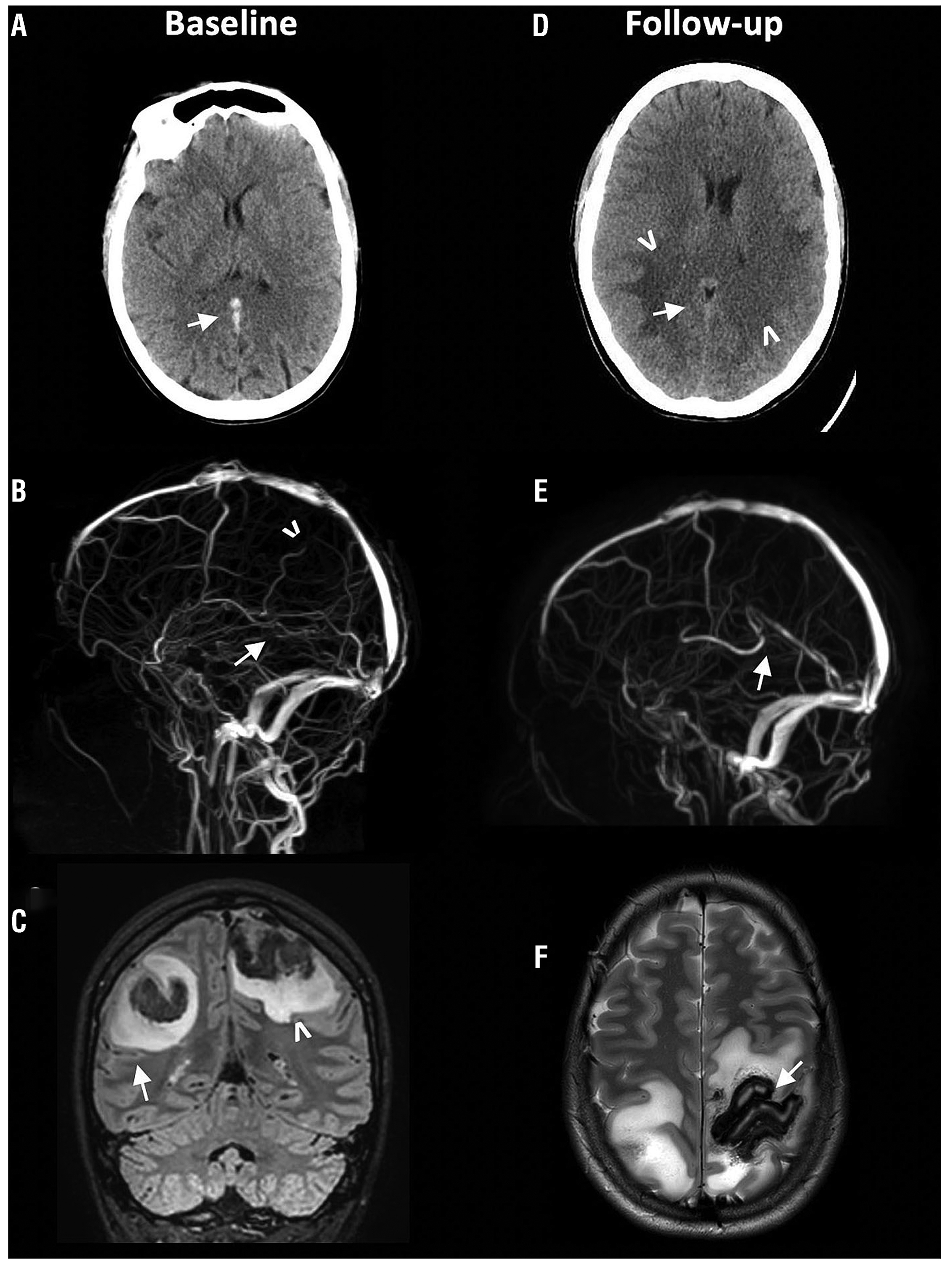 Using CT Scans for Finding Blood Clots